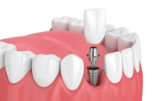 Implantes dentales