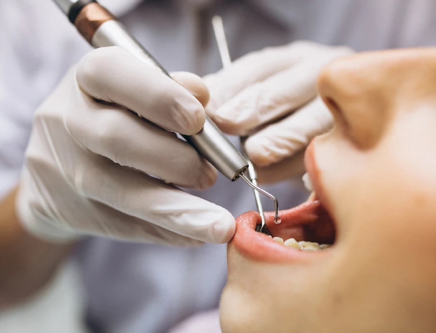 Curación de caries dentales